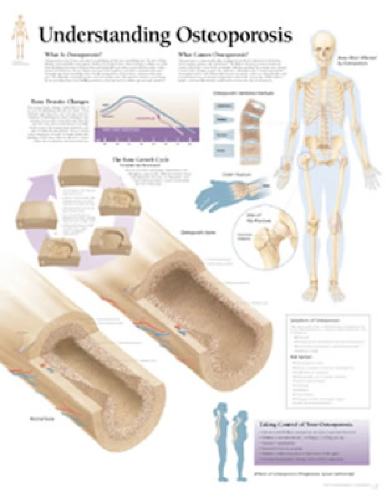 Understanding Osteoporosis Laminated Poster