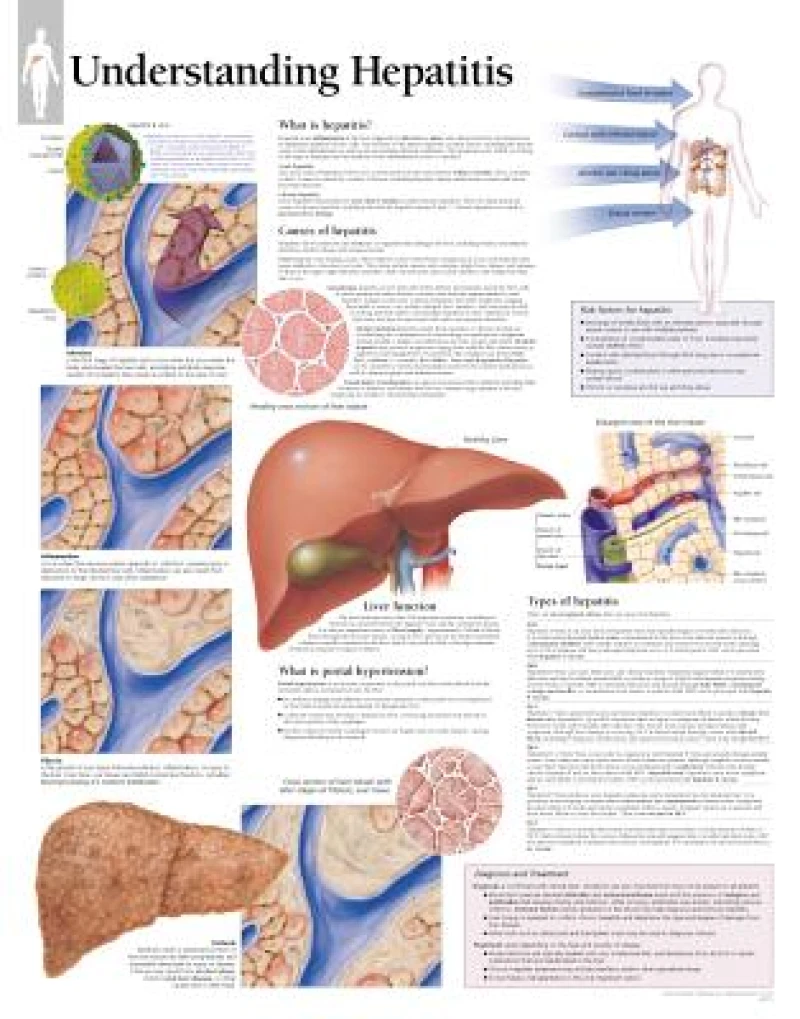 Understanding Hepatitis Laminated Poster