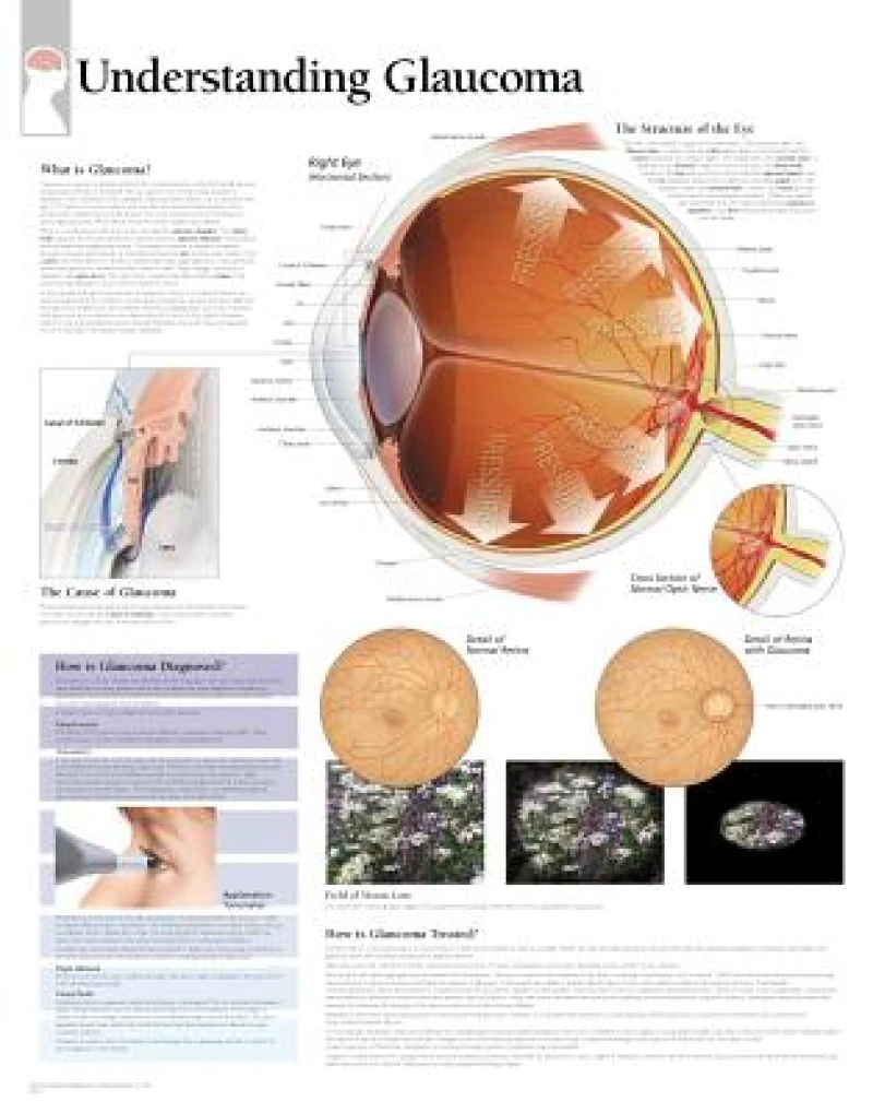 Understanding Glaucoma Paper Poster