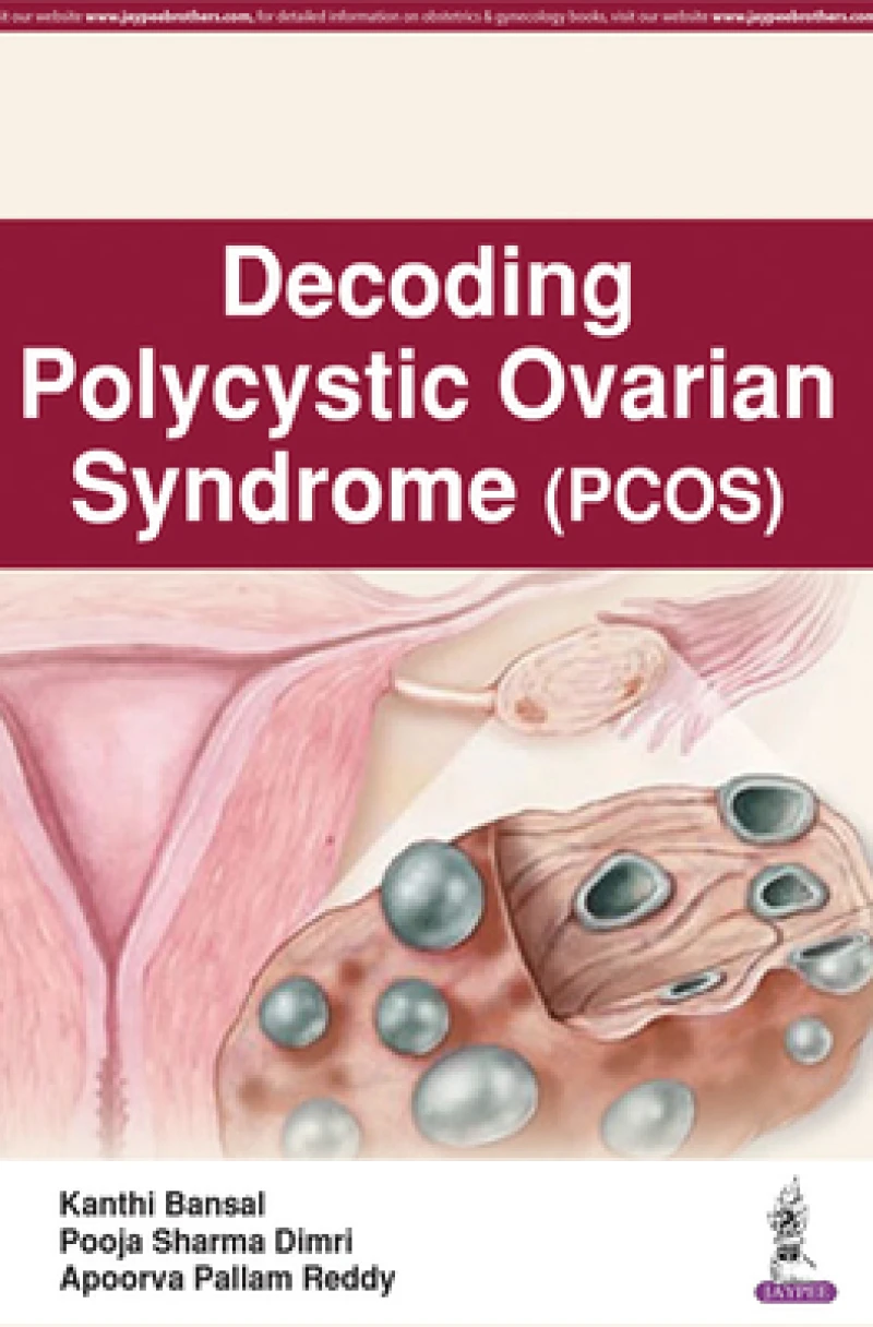 Decoding Polycystic Ovarian Syndrome